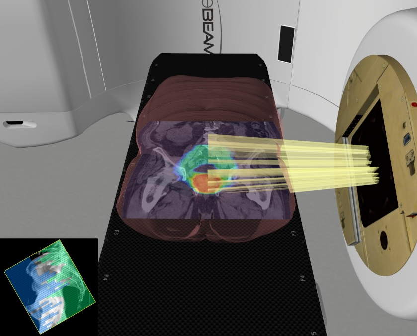 Projection en 3D d’un traitement de prostate et visualisation de la dose.