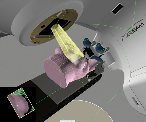 Projection en 3D d’un traitement d’un sein.