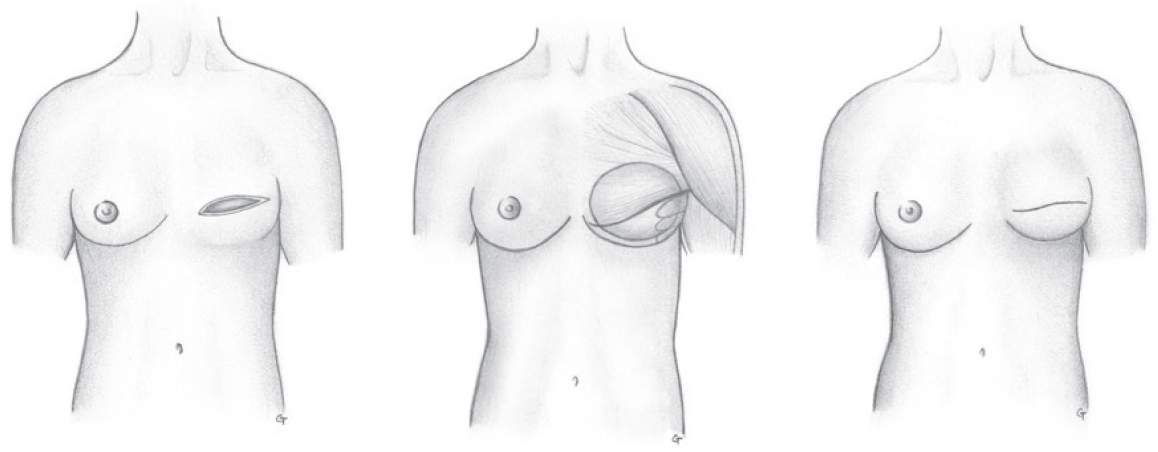 reconstruction mammaire