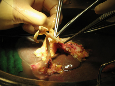 transplantation foie