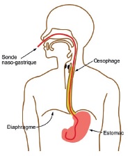 Sonde nasogastrique