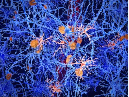 En orange, les plaques amyloïdes