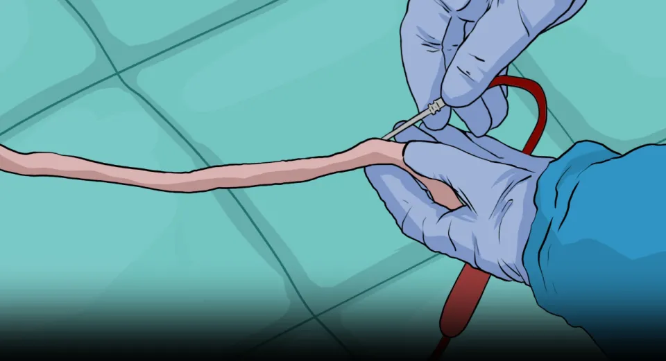 Le prélèvement se fait tout de suite après la naissance sur le cordon ombilical ombilical 