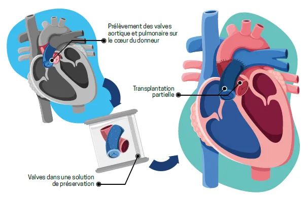 Illustration d'une transplantation cardiaque partielle - Lucie Ménard