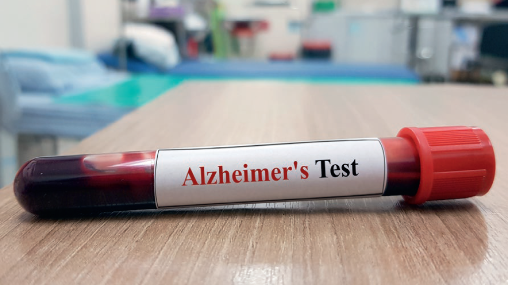 Blood-based biomarkers for alzheimer’s disease could greatly simplify diagnosis and reduce costs © joel bubble ben-Shutterstock.com