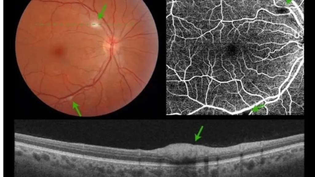 Anomalies rétiniennes chez un patient hospitalisé pour une infection à SARS-COV-2 - HUG