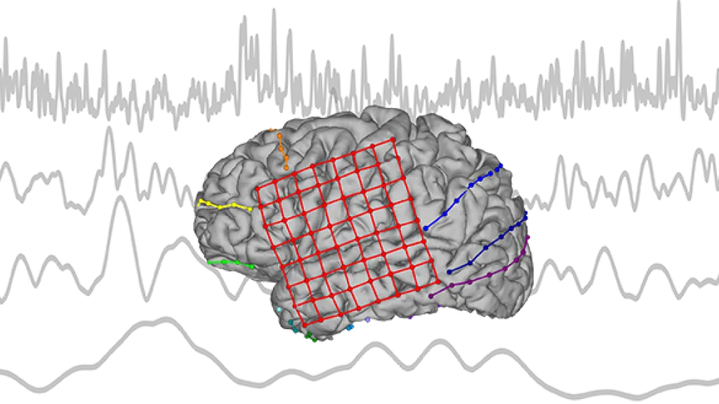 Décoder le langage intérieur pour soigner les troubles de la parole  - © UNIGE