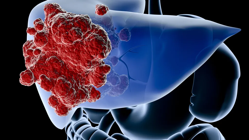 Cancer du foie et obésité maternelle 