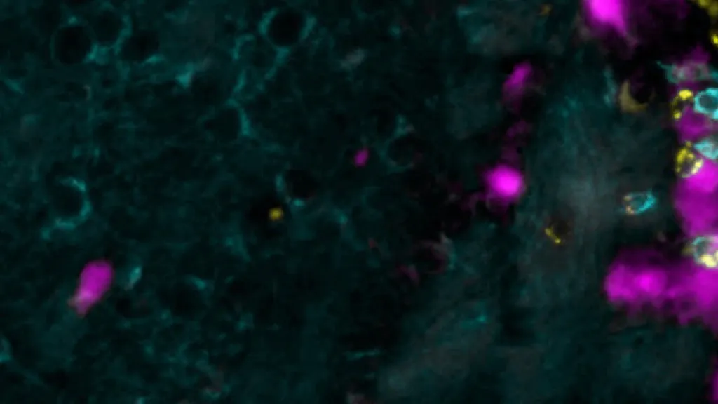 La sclérose en plaques liée aux infections virales infantiles ? 