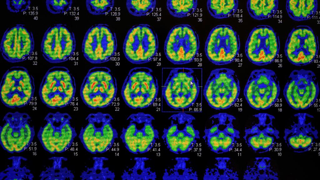 Images d'un scanner d'un cerveau