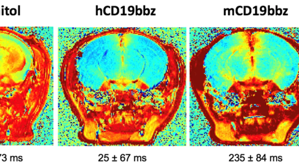 Cette IRM à haute résolution démontre que les cellules CD19 CAR-T induisent une perméabilisation de la barrière hématoencéphalique dans le cerveau des souris, reproduisant la neurotoxicité observée chez l’homme. @UNIGE