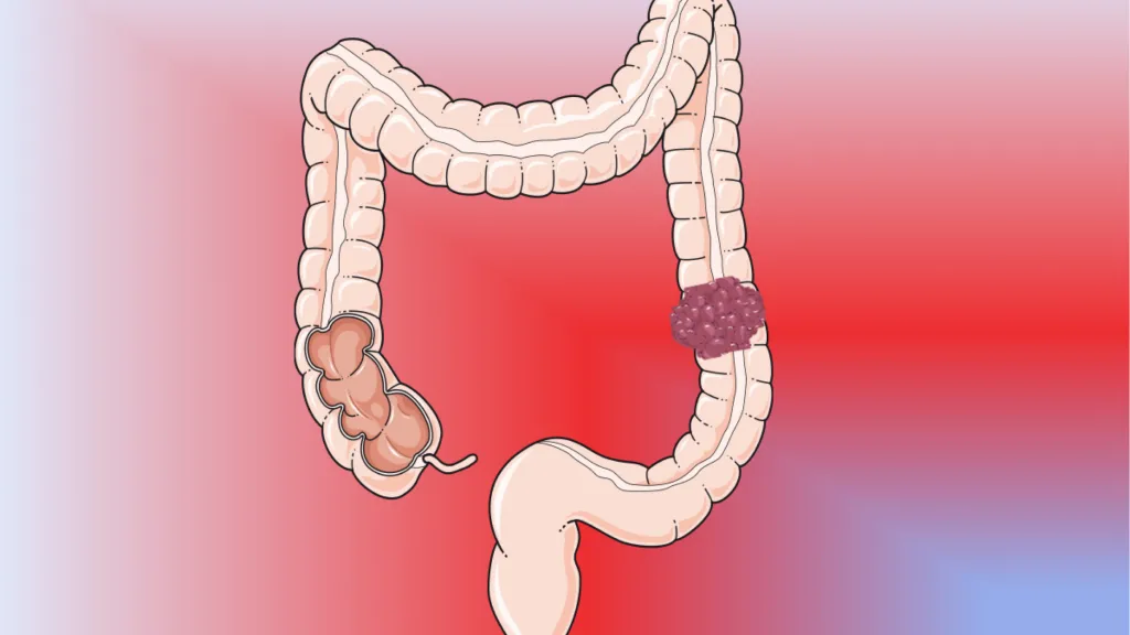 Dessin schématique du côlon et d’un carcinome colorectal - Copyright : UNIGE