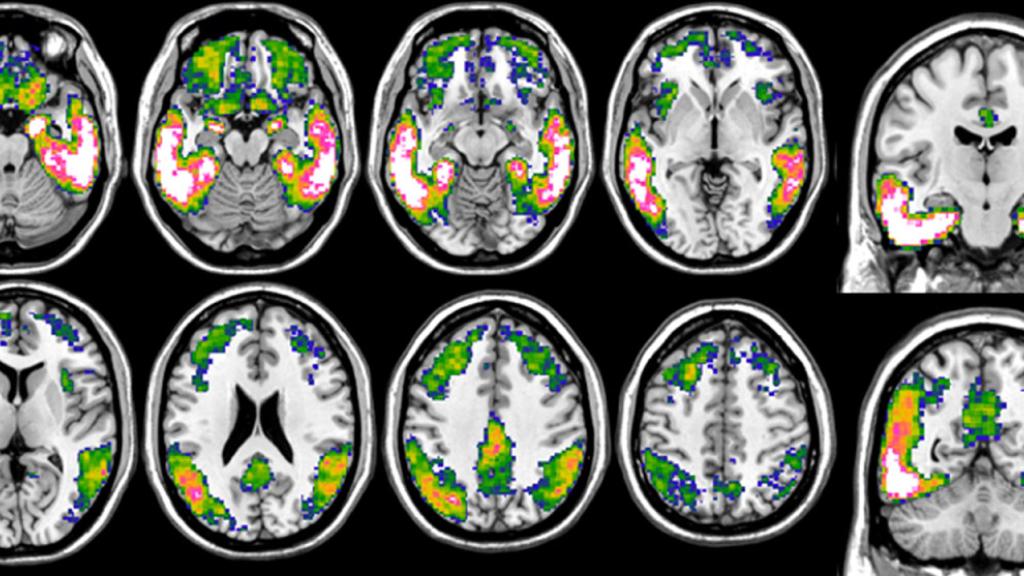Imagerie de cerveaux de patient-es atteint-es de la maladie d'Alzheimer