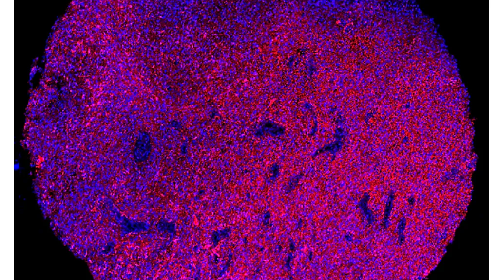 Immunofluorescence staining of a representative human glioblastoma tissue section. In red, the PTPRZ1 markers, and in blue, the cell nuclei. (scale bar: 400 μm) © Denis Migliorini - UNIGE/HUG