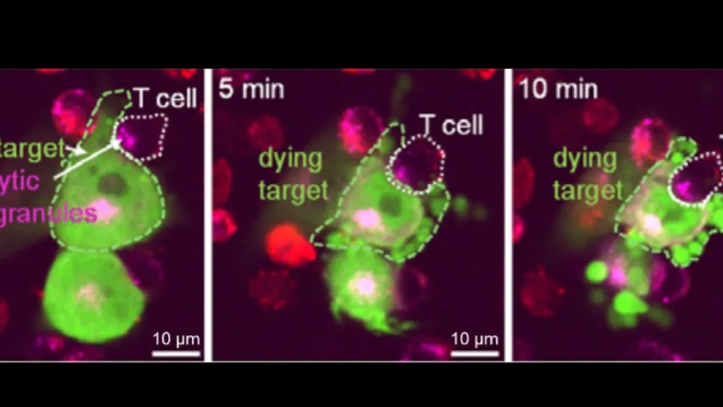 CAR-T cells - Des cellules sur mesure contre le cancer du cerveau