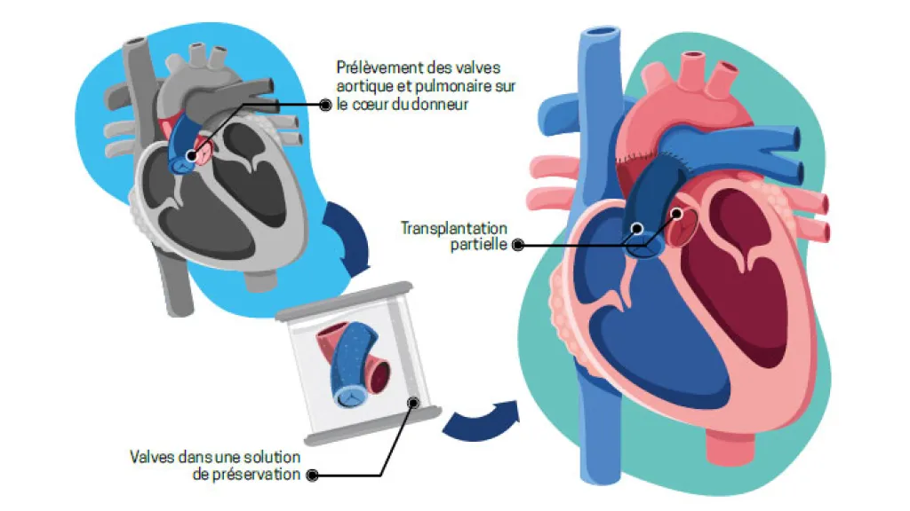Illustration d'une transplantation cardiaque partielle - Lucie Ménard