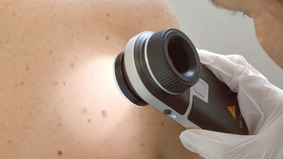 Dépistage mélanome