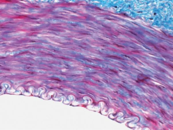 Hypertension artérielle pulmonaire