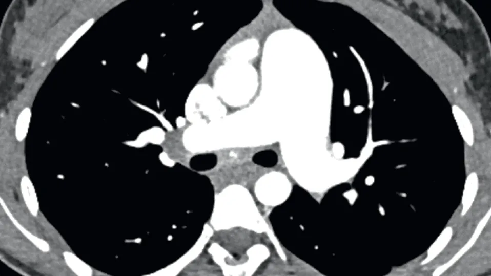 Symposium romand d’hypertension artérielle pulmonaire