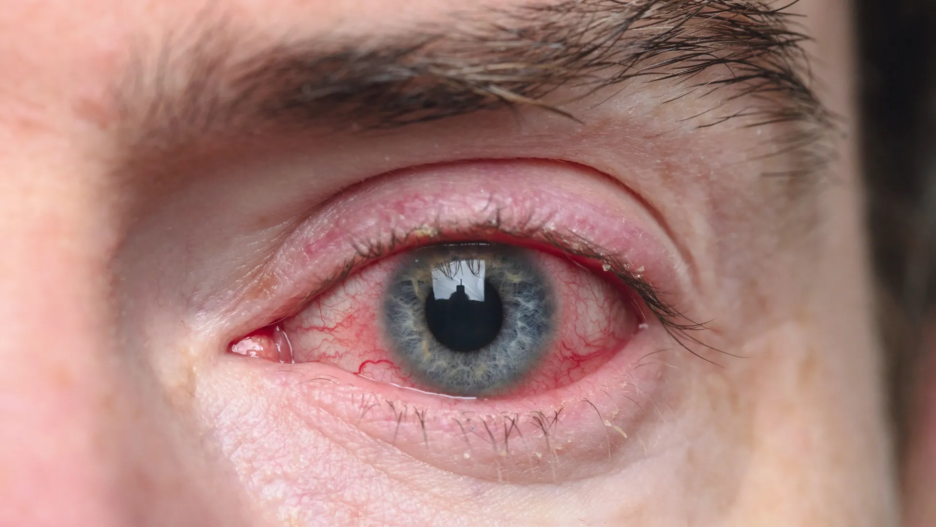 Œil souffrant d'inflammation