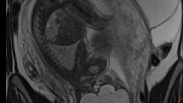 Colloque cancer et grossesse