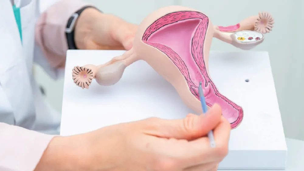 brochure gipp : la conisation