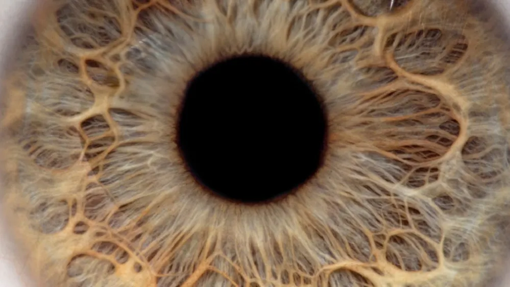 L'opération du kératocône