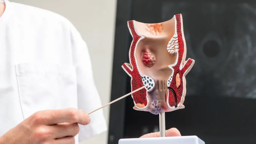 La chirurgie proctologique