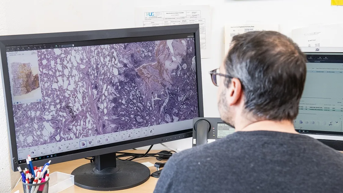 Accès à des traitements innovants contre le cancer du poumon