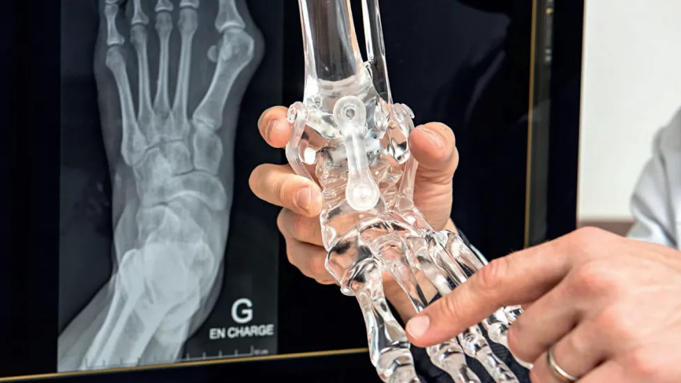 Brochure : hallux vallgus