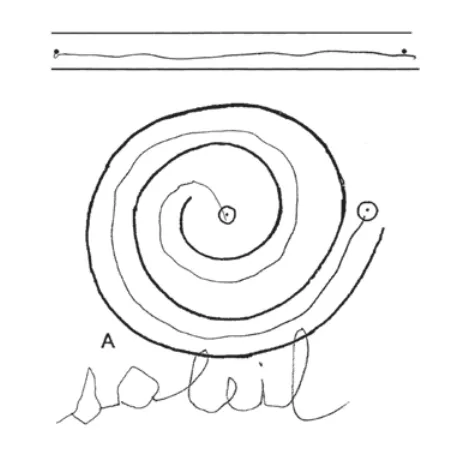 exemple amélioration : immédiatement après la FUS