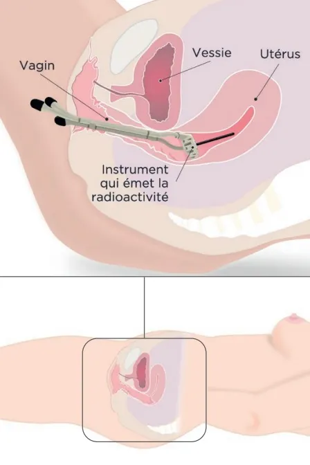 Positionnement de l’applicateur dans le vagin