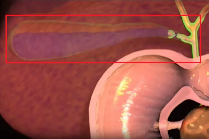 ablation de la vésicule biliaire 