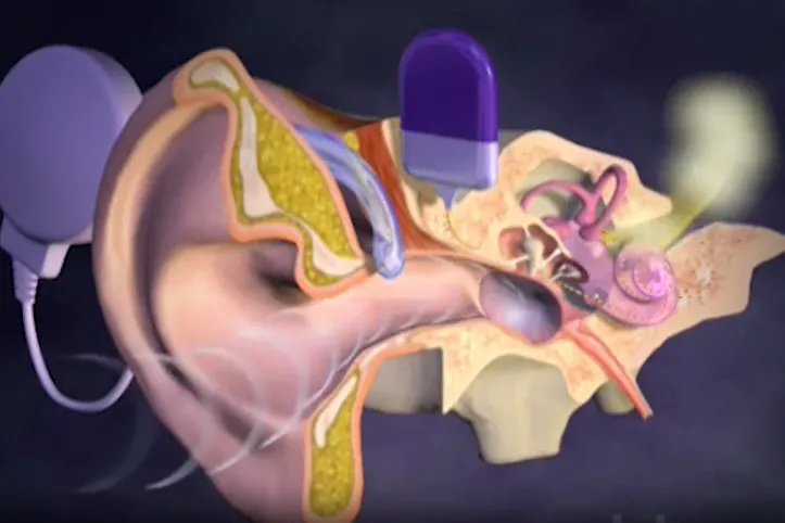 Fonctionnement de l'implant cochléaire