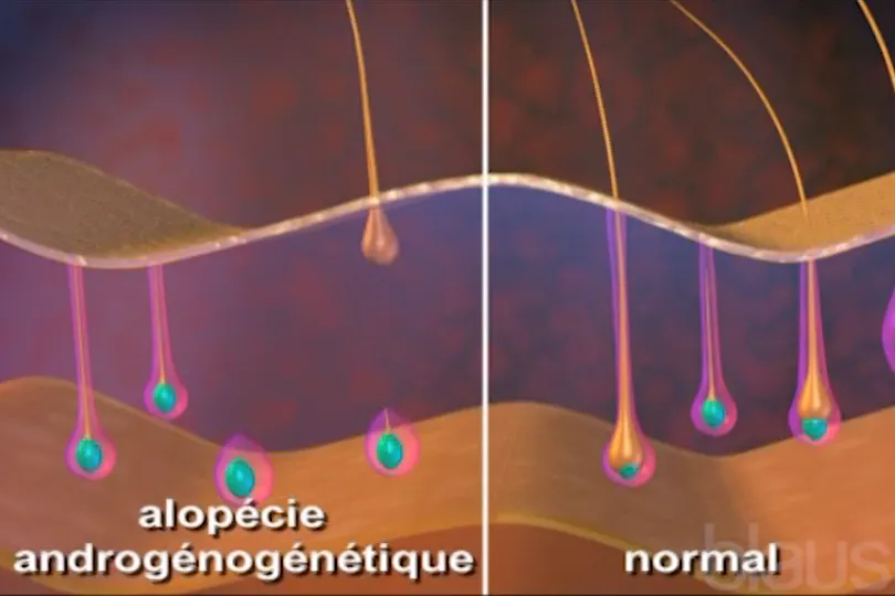 Alopécie androgénétique