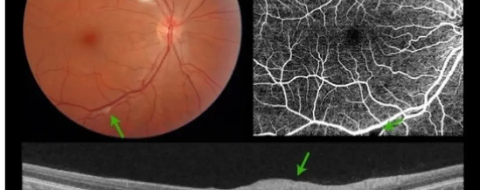 Anomalies rétiniennes chez un patient hospitalisé pour une infection à SARS-COV-2 - HUG