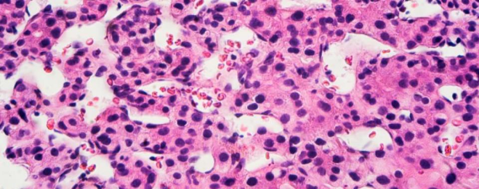 Image par microscopie d’un carcinome hépatocellulaire - Unige.ch