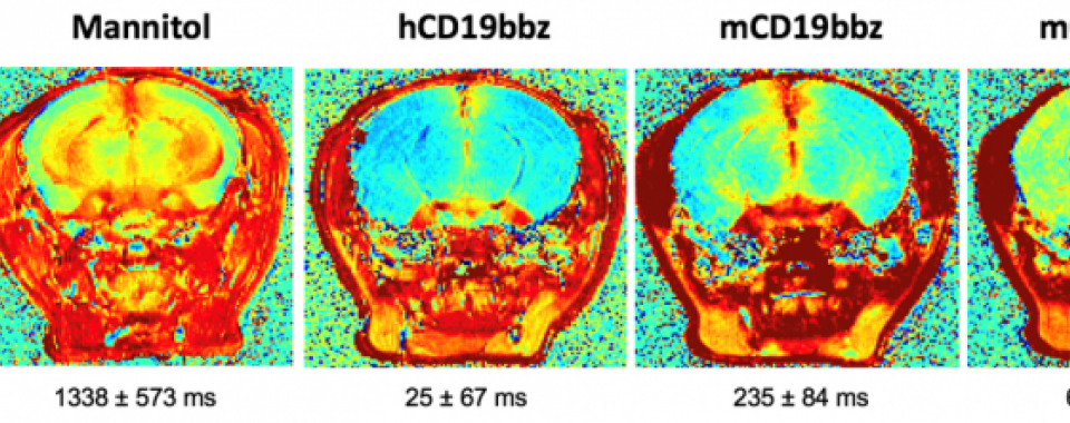 Cette IRM à haute résolution démontre que les cellules CD19 CAR-T induisent une perméabilisation de la barrière hématoencéphalique dans le cerveau des souris, reproduisant la neurotoxicité observée chez l’homme. @UNIGE