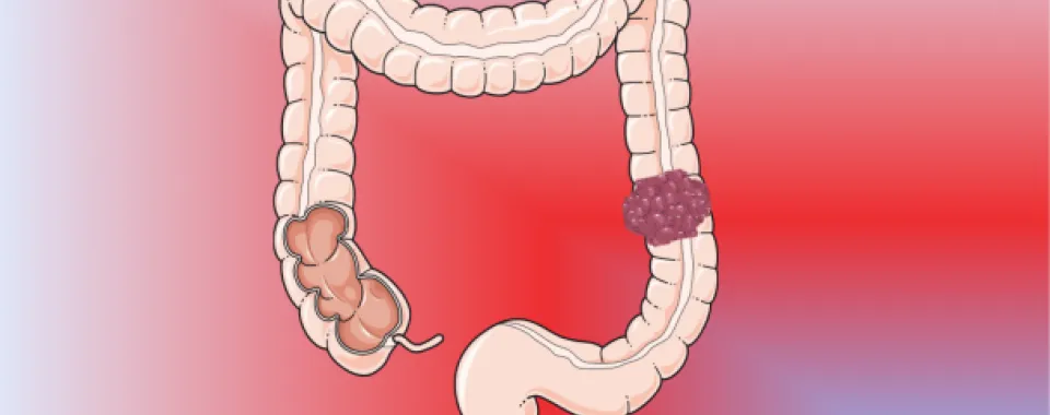 Dessin schématique du côlon et d’un carcinome colorectal - Copyright : UNIGE