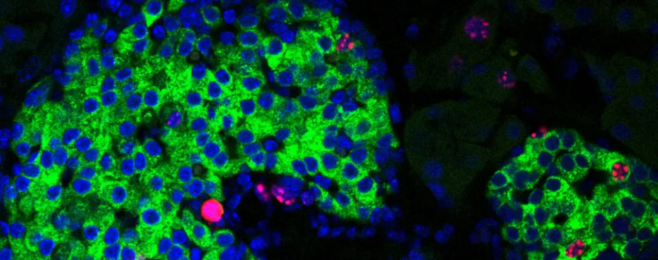 Les lipides et le diabète sont étroitement liés