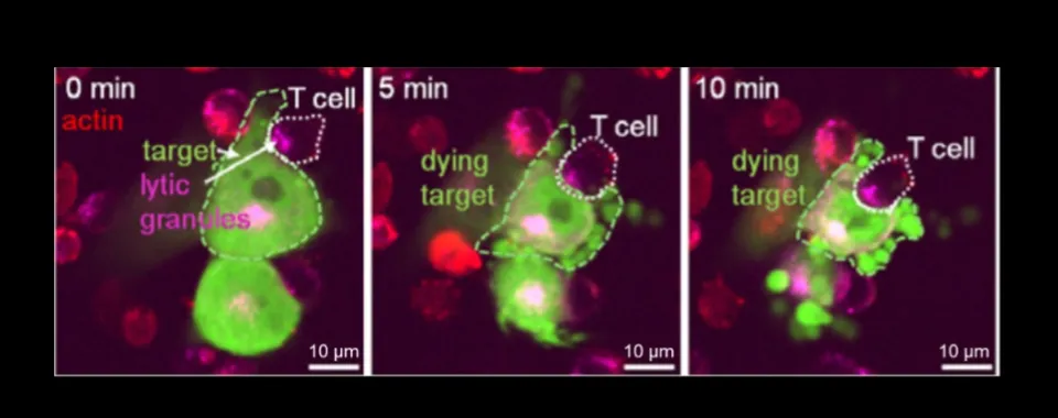 CAR-T cells - Des cellules sur mesure contre le cancer du cerveau