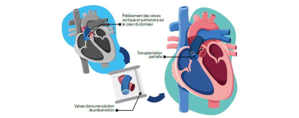 Illustration d'une transplantation cardiaque partielle - Lucie Ménard