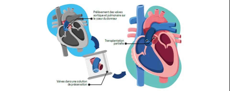 Illustration d'une transplantation cardiaque partielle - Lucie Ménard